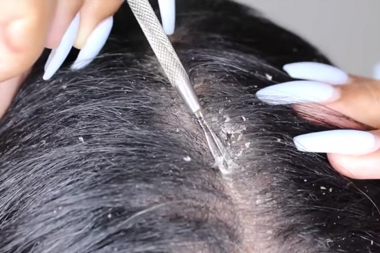 woman scratching dandruff from her scalp