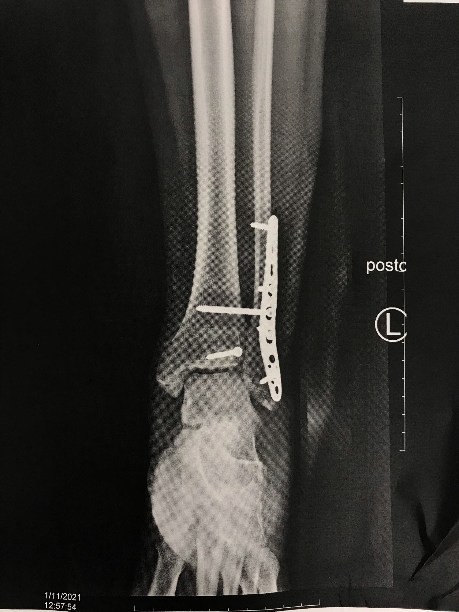 an x-ray of a leg