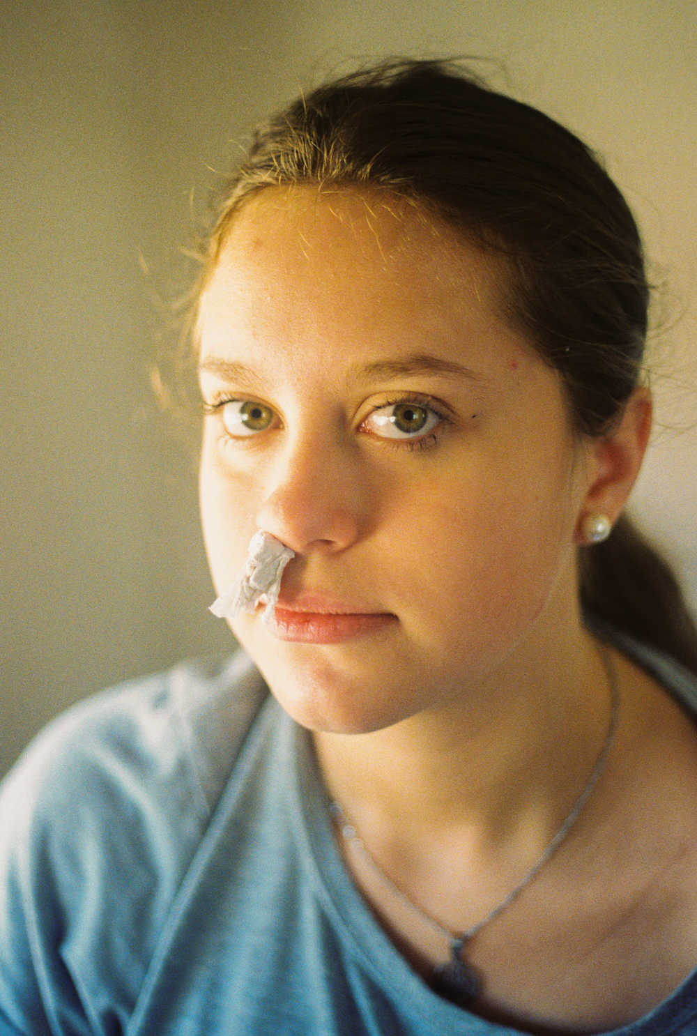 Close up of a girl with tissue scrunched up her nose to stop a nosebleed.