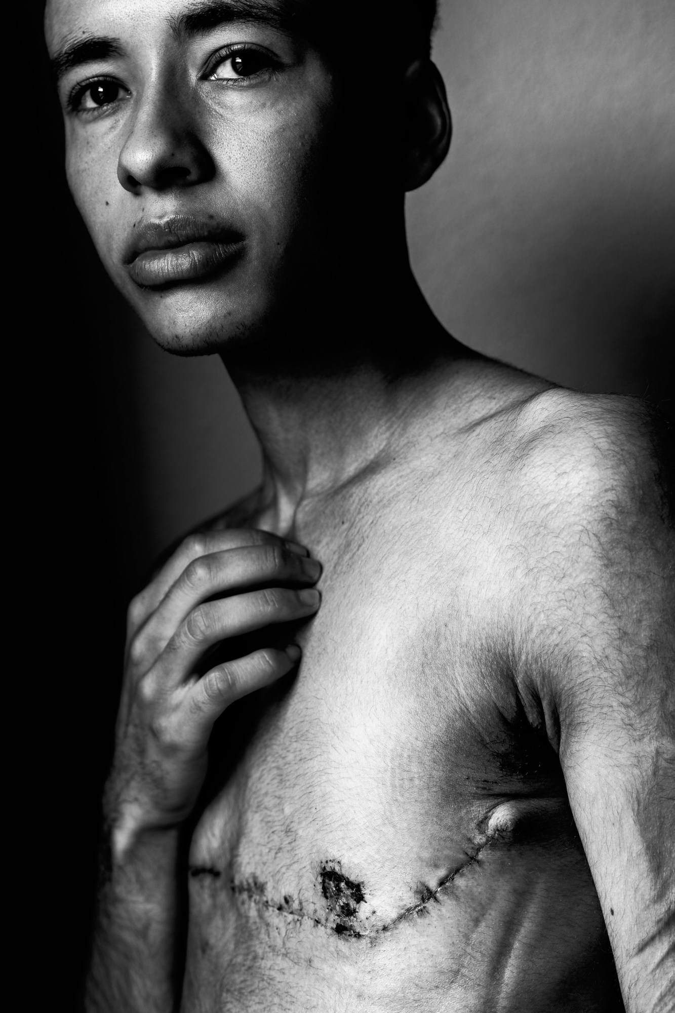 the scars of gender-confirmation surgery across a person's chest