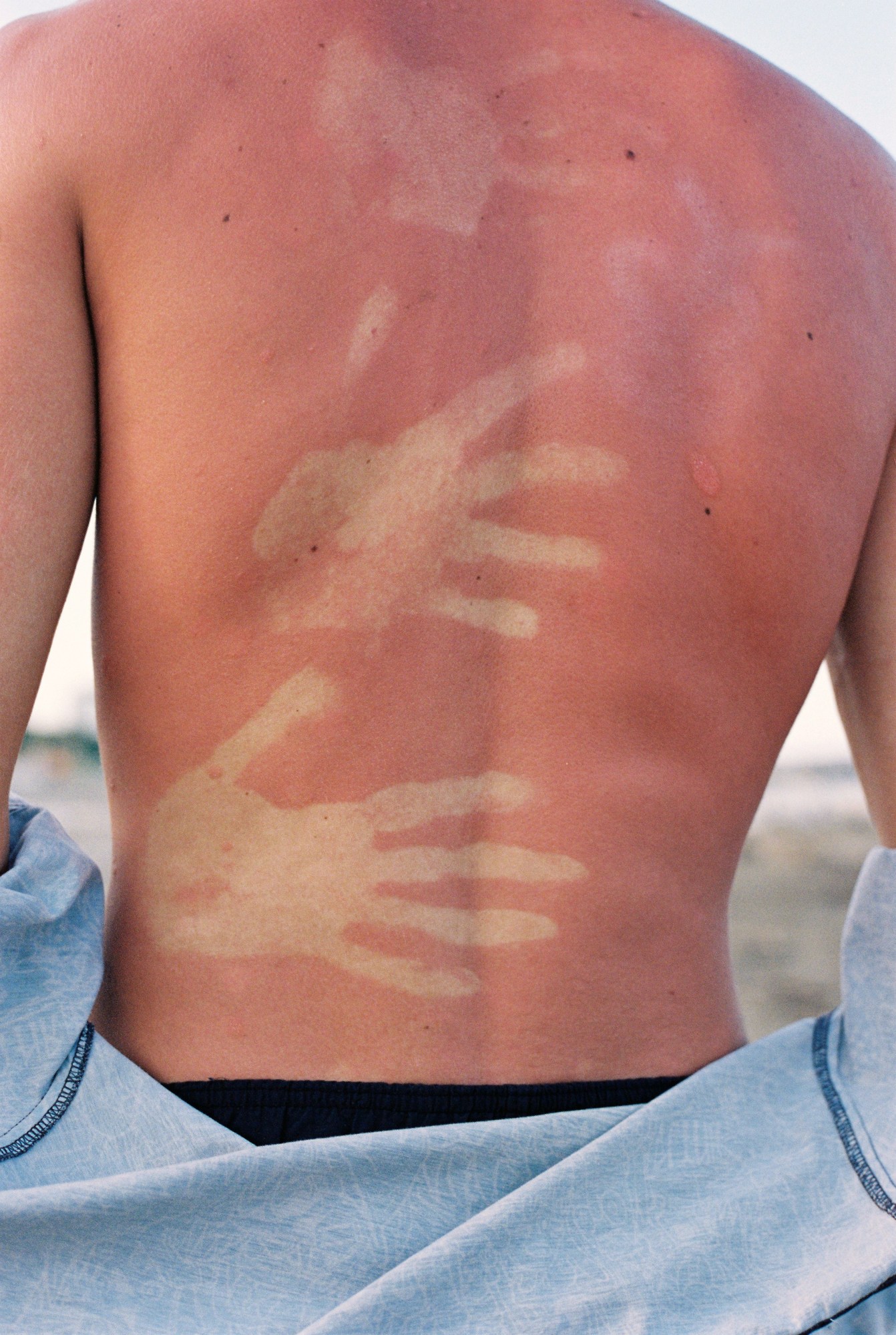 A man on the beach takes off his shirt revealing hand shaped sun burns on his back.