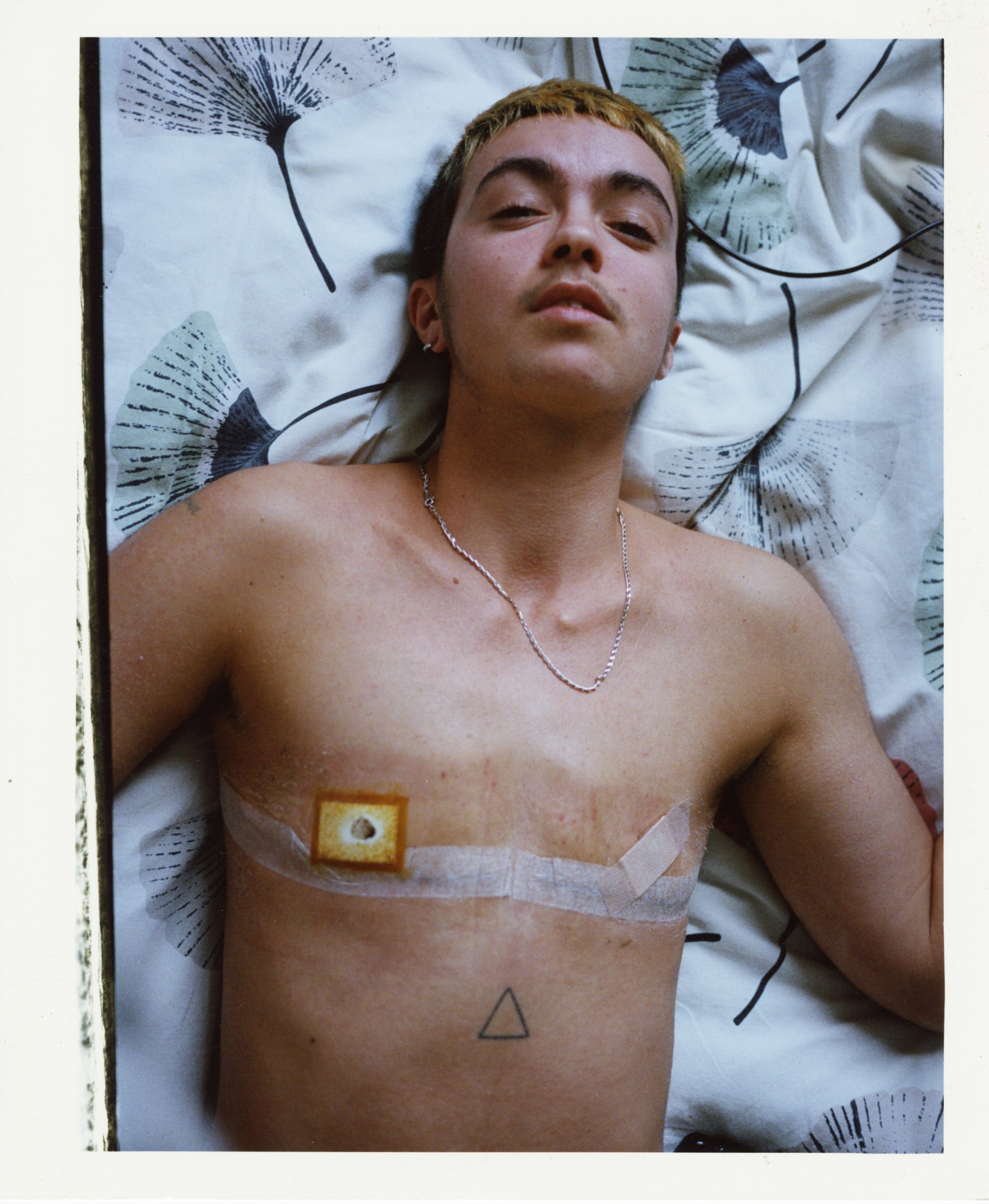 A shirtless person lying on a bed after having top surgery with tape and plasters along their body.