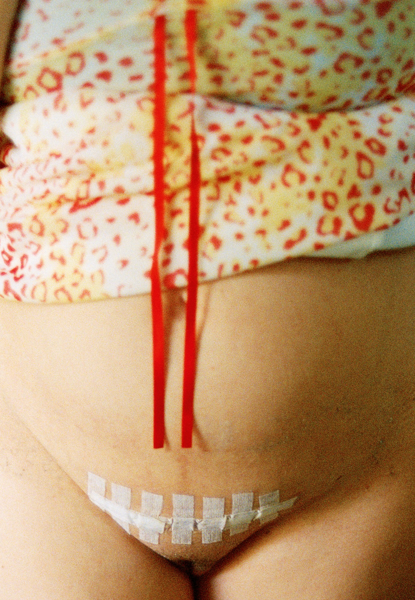 A pregnancy belly with a bandaged scar.