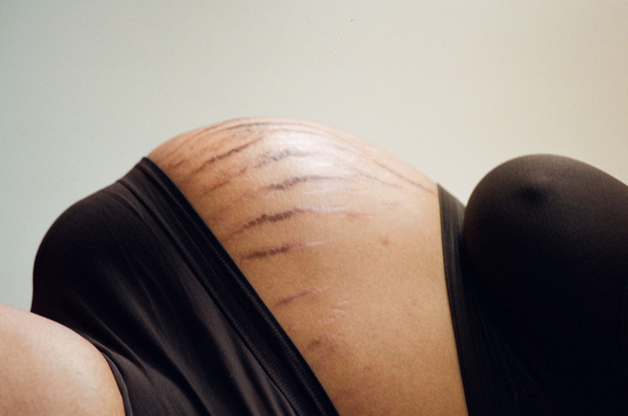 a pregnant woman with large stretch marks