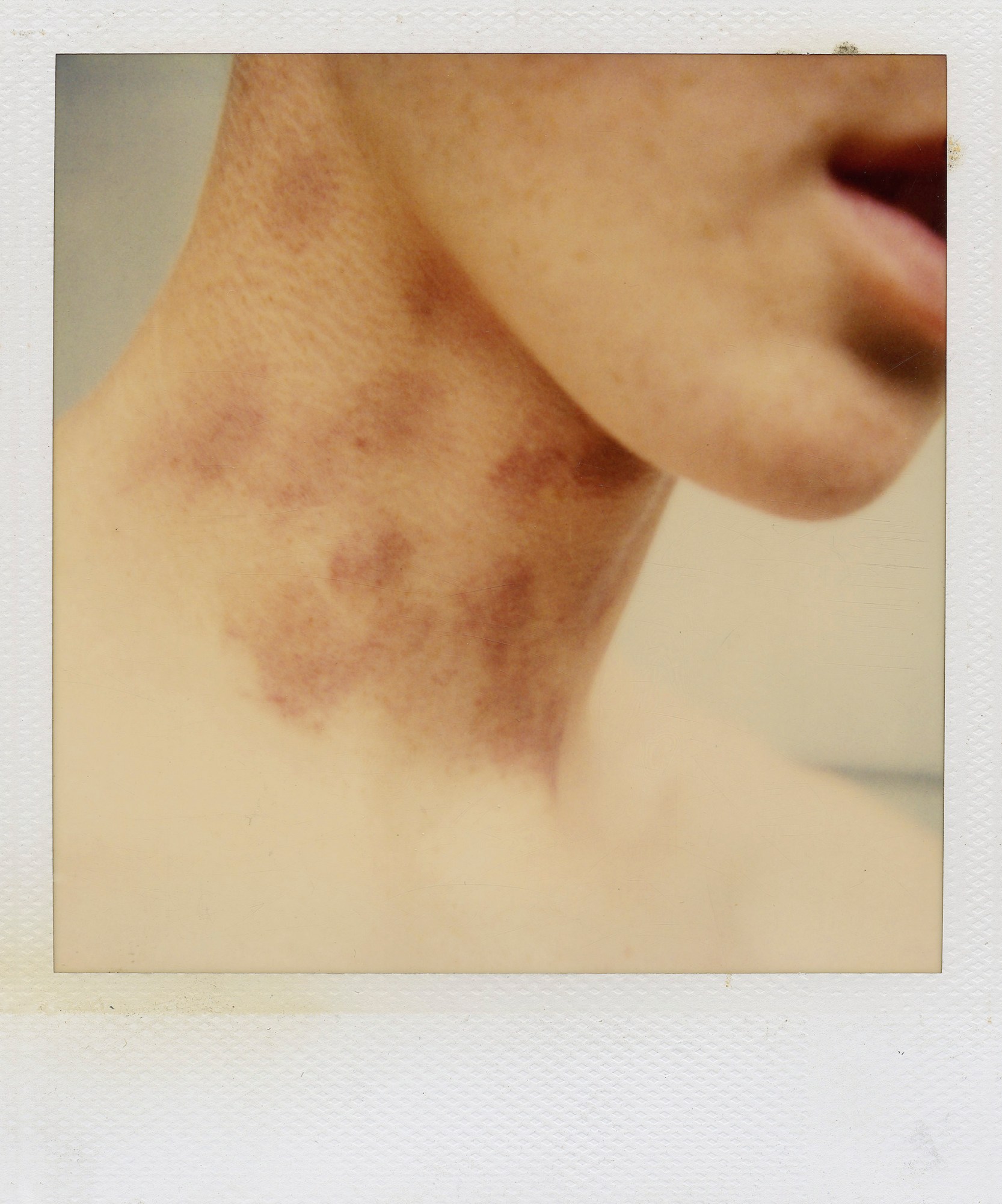 a polaroid of a close up of a model's neck covered in small bruises