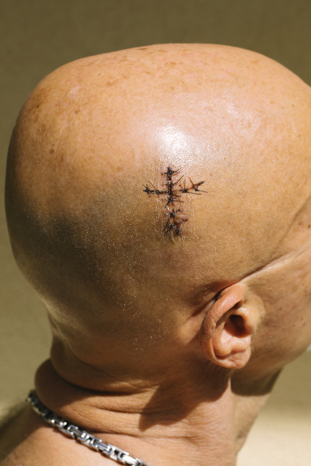 a bald man wearing a silver chain; he is shot from the side and has stitches in his head in the shape of a crucifix