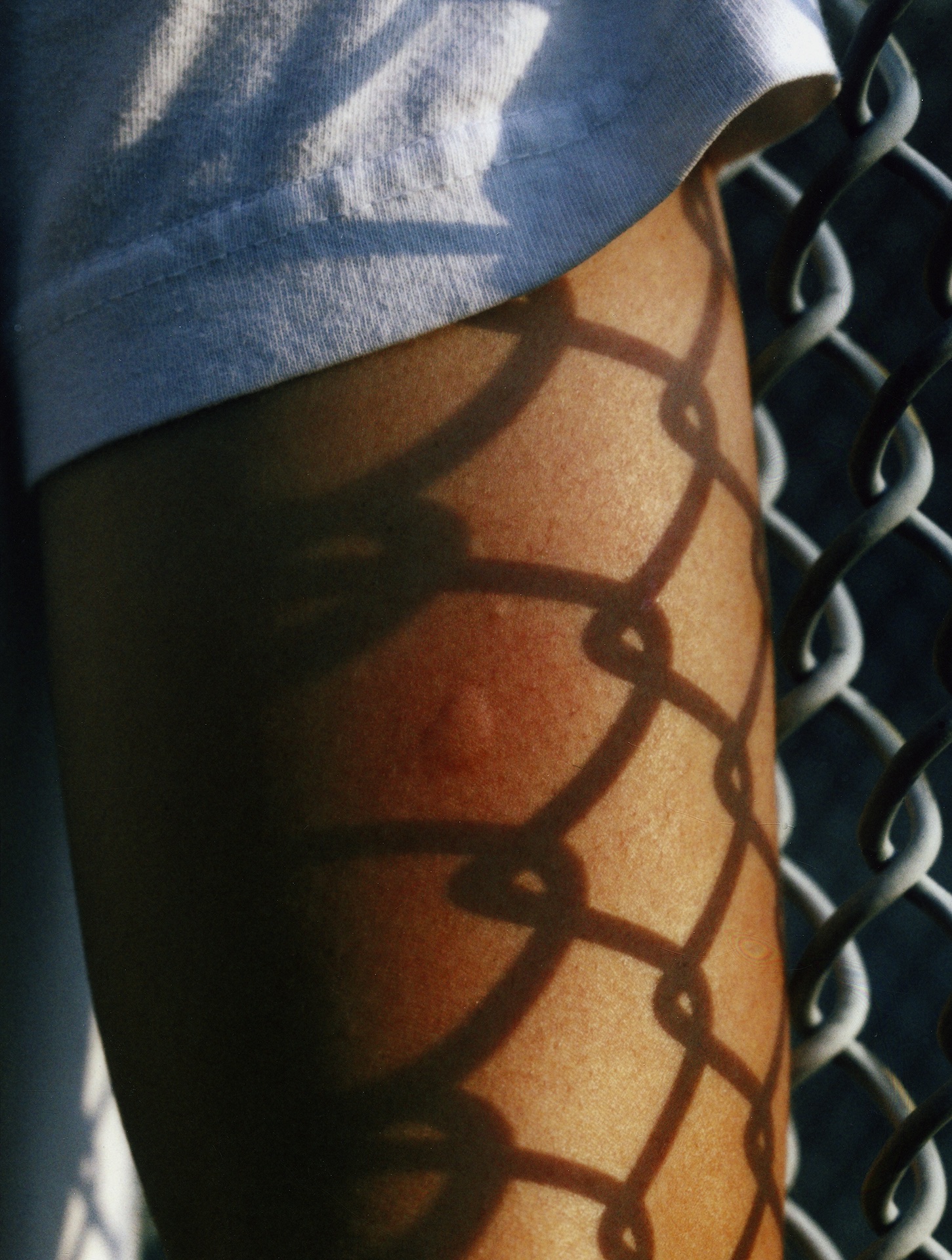 a picture of a bee sting on a woman's arm. a chainlink fence is behind her.